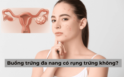 [Giải đáp] Buồng trứng đa nang có rụng trứng không? Cách chữa hiệu quả