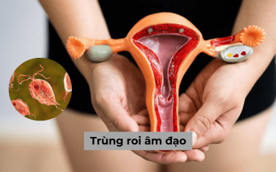 Trùng roi âm đạo là gì? Triệu chứng nhận biết nhiễm trùng roi