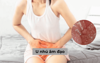 U nhú âm đạo là bệnh gì? Biến chứng và cách điều trị hiệu quả