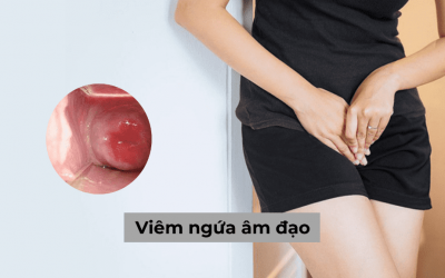 Viêm ngứa âm đạo là gì: Nguyên nhân và cách khắc phục hiệu quả