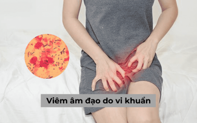 Tổng hợp từ A – Z về viêm âm đạo do vi khuẩn ở nữ giới