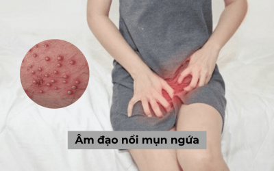 Âm đạo nổi mụn ngứa: Nguyên nhân bệnh lý cần phải chú ý!