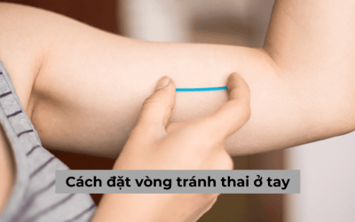 Cách đặt vòng tránh thai ở tay như thế nào? Có nên đặt không?