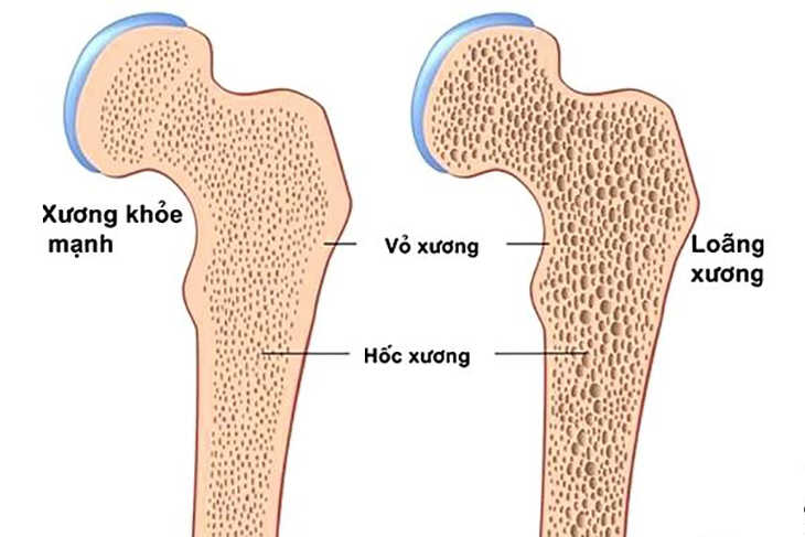 Gây loãng xương tạm thời