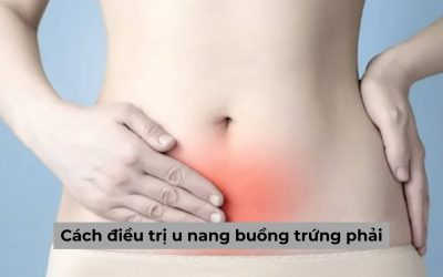 Cách điều trị u nang buồng trứng phải hiệu quả? Những lưu ý sau trị bệnh