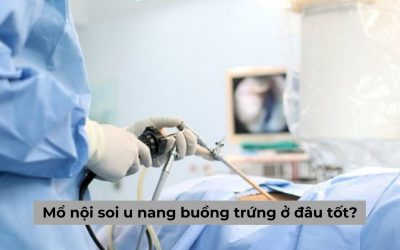 Mổ nội soi u nang buồng trứng ở đâu tốt? Gợi ý 5 địa chỉ uy tín hàng đầu