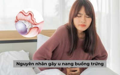 Nguyên nhân gây u nang buồng trứng và những thông tin bạn cần chú ý