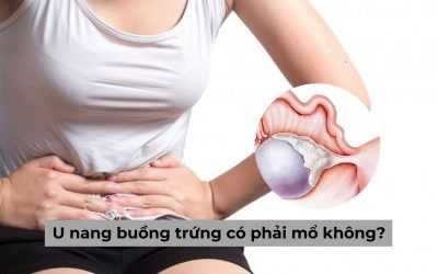 [Góc giải đáp] U nang buồng trứng có phải mổ không?