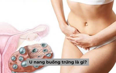 [Chuyên gia lý giải] U nang buồng trứng là gì? Có điều trị được không?