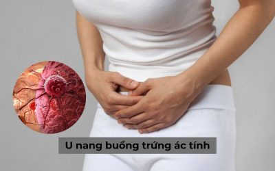 U nang buồng trứng ác tính và những vấn đề chị em cần biết