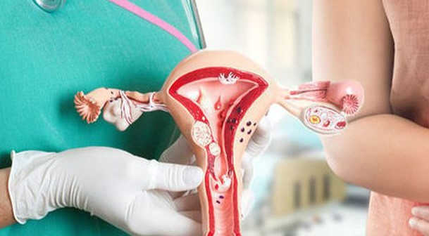 Những vấn đề cần lưu ý khi mổ u nang buồng trứng