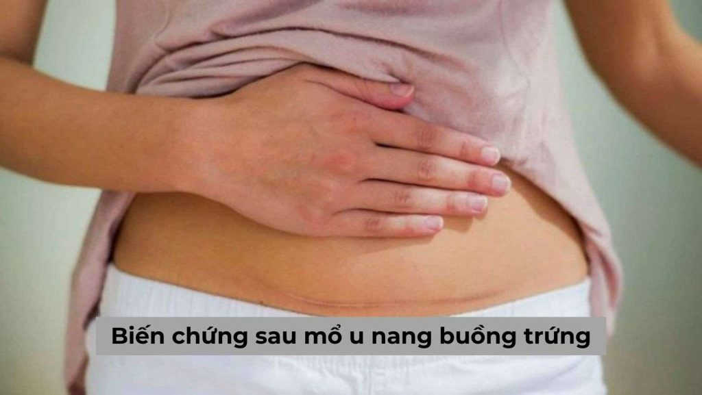 [Giải đáp thắc mắc] Biến chứng sau mổ u nang buồng trứng là gì?