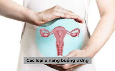 [Tổng hợp] Tìm hiểu các loại u nang buồng trứng ở nữ giới
