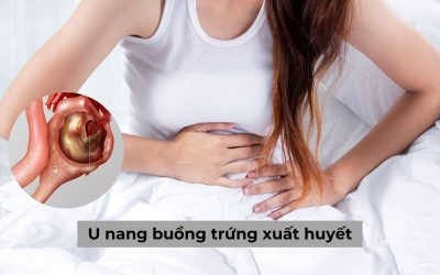 U nang buồng trứng xuất huyết: Nguyên nhân và ảnh hưởng nguy hiểm