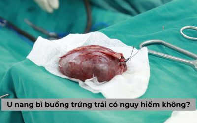 Tìm hiểu u nang bì buồng trứng trái có nguy hiểm không?