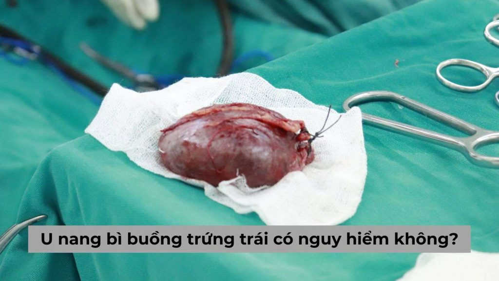 Tìm hiểu u nang bì buồng trứng trái có nguy hiểm không?