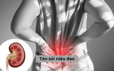 [Tìm hiểu] Cập nhật thông tin từ A – Z về tán sỏi niệu đạo