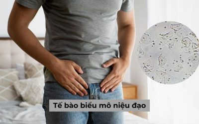 Ý nghĩa và ứng dụng của tế bào biểu mô niệu đạo trong xét nghiệm