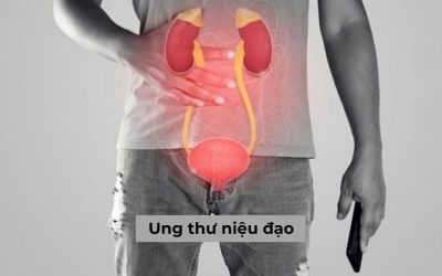 Ung thư niệu đạo: Căn nguyên, triệu chứng, cách chẩn đoán và điều trị