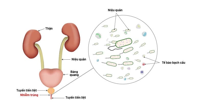 Nguyên nhân có thể gây ra viêm nhiễm niệu đạo