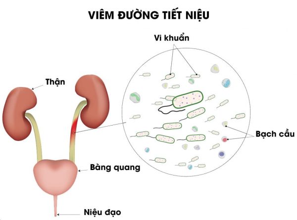 Nhiễm trùng đường tiết niệu