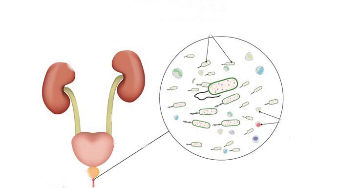 Nguyên nhân viêm niệu đạo ở namNguyên nhân viêm niệu đạo ở nam