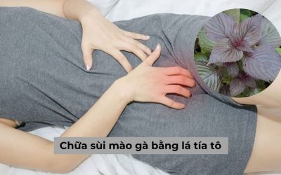 Chữa sùi mào gà bằng lá tía tô có hiệu quả thật không?