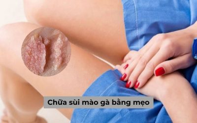 Bác sĩ giải đáp: Có nên tự chữa sùi mào gà bằng mẹo?