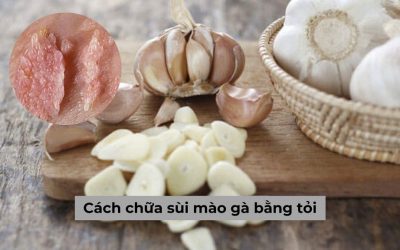 Cách chữa sùi mào gà bằng tỏi liệu thực sự có tốt như lời đồn?