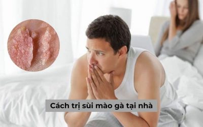 Review những cách trị sùi mào gà tại nhà, đâu là phương pháp hiệu quả?