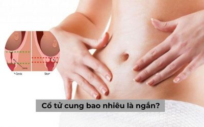Cổ tử cung bao nhiêu là ngắn? Gây ra ảnh hưởng gì? 