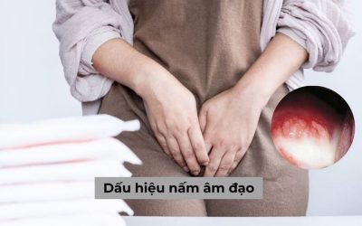 5 Dấu hiệu nấm âm đạo điển hình & Cách chữa dứt điểm hiện nay