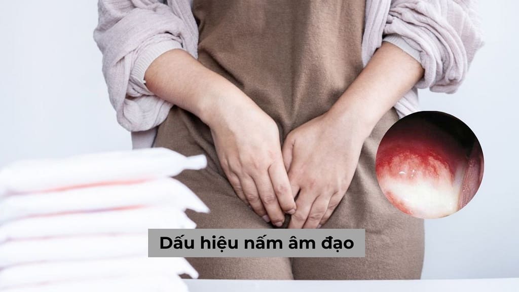 5 Dấu hiệu nấm âm đạo điển hình & Cách chữa dứt điểm hiện nay