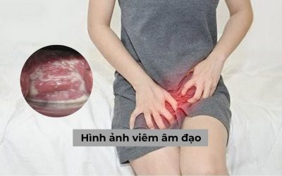 Cách nhận biết hình ảnh viêm âm đạo và biến chứng có thể gặp phải