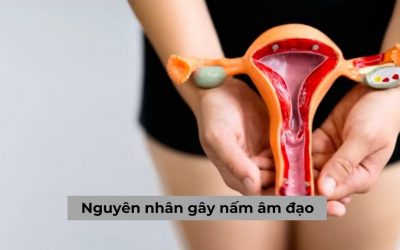 Nguyên nhân gây nấm âm đạo do đâu & Cách chữa hiện nay