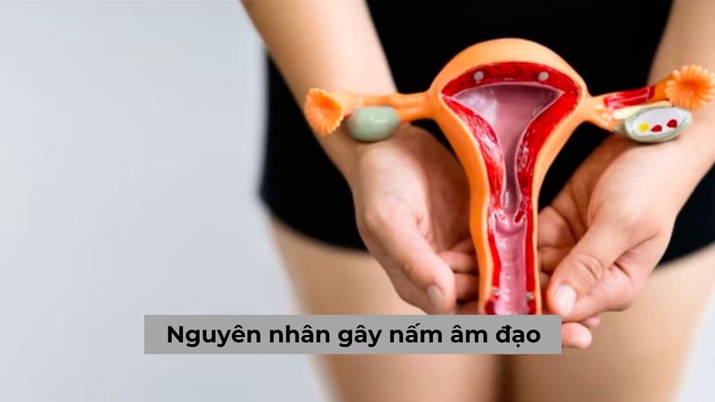 Nguyên nhân gây nấm âm đạo do đâu & Cách chữa hiện nay