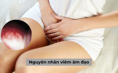 Tổng hợp 5 nguyên nhân viêm âm đạo thường gặp nhất ở nữ giới