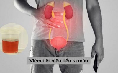 Tất tần tật về viêm tiết niệu tiểu ra máu ai cũng cần biết