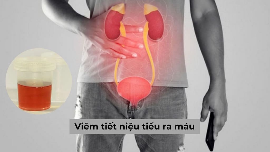 Tất tần tật về viêm tiết niệu tiểu ra máu ai cũng cần biết