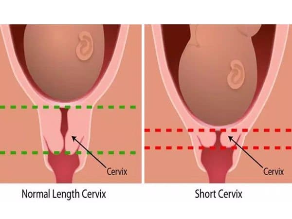 Chiều dài cổ tử cung bao nhiêu là ngắn?