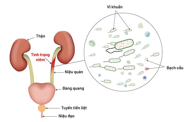 Khi gặp hiện tượng đi tiểu ra máu thì có cần phải đi khám không?