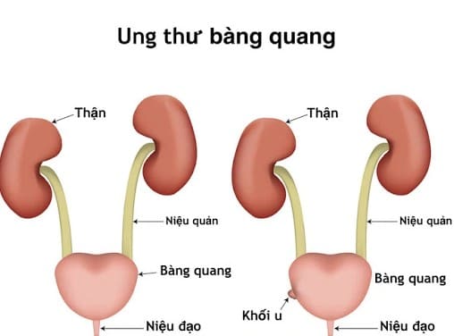 Ung thư thận/ bàng quang