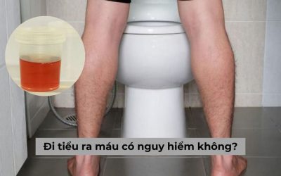 Chuyên gia giải đáp: Đi tiểu ra máu có nguy hiểm không?