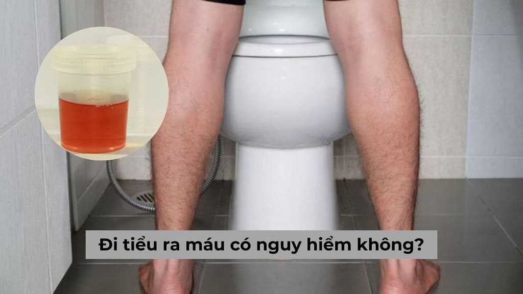 Chuyên gia giải đáp: Đi tiểu ra máu có nguy hiểm không?