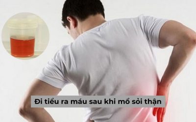 Triệu chứng đi tiểu ra máu sau khi mổ sỏi thận có đáng lo ngại không?