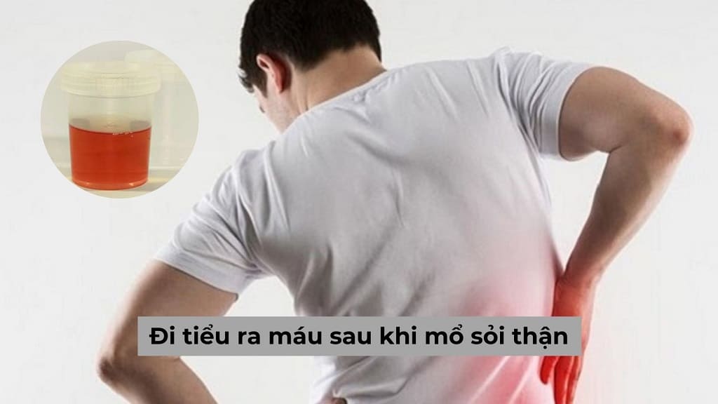 Triệu chứng đi tiểu ra máu sau khi mổ sỏi thận có đáng lo ngại không?