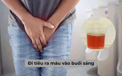 Đi tiểu ra máu vào buổi sáng liệu có phải dấu hiệu nguy hiểm?