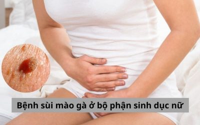 Cập nhật chi tiết về bệnh sùi mào gà ở bộ phận sinh dục nữ