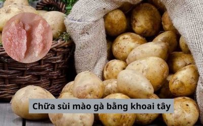 Chữa sùi mào gà bằng khoai tây có thực sự hiệu quả? [Giải đáp]