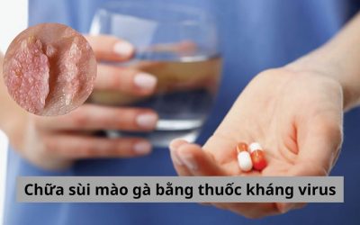 Chữa sùi mào gà bằng thuốc kháng virus có hiệu quả không? 